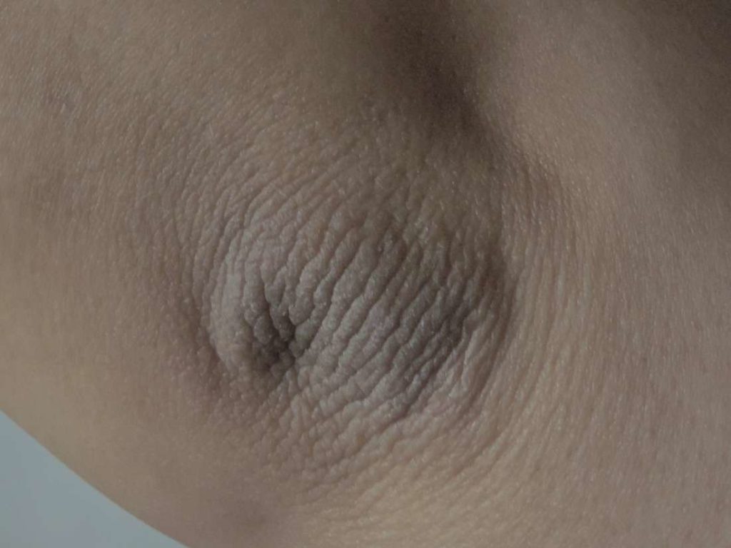 Acanthosis Nigricans What You Should Know