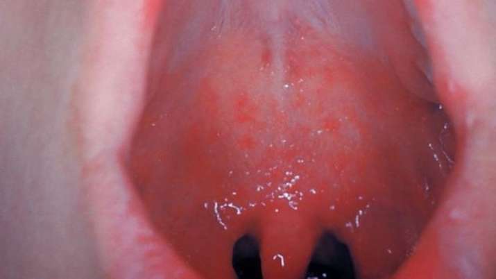 covid-mouth-rash-enanthem-joins-covid-19-symptoms-2024